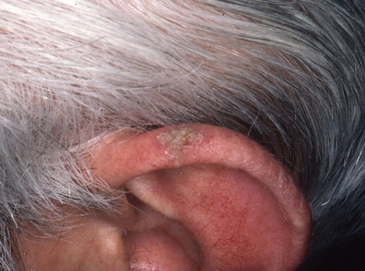 Lesión hiperqueratósica en la oreja izquierda