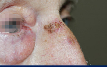 Lesión ulcerosa de queratosis actínica