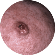 Carcinoma celular escamoso invasivo
